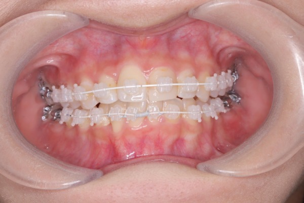 金属アレルギーの非抜歯症例＿表側矯正