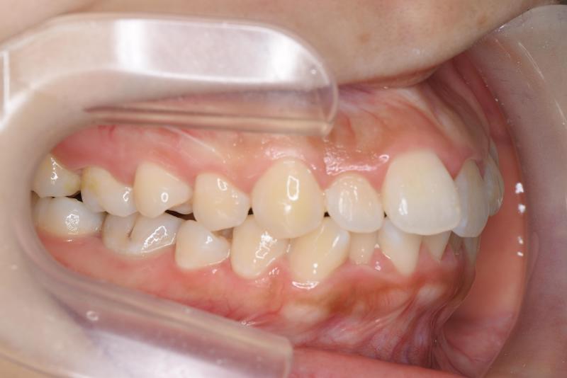 口ごぼ＿上下顎抜歯症例（表側矯正装置）