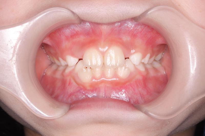 上下顎側切歯のスペース不足（第Ⅰ期矯正）