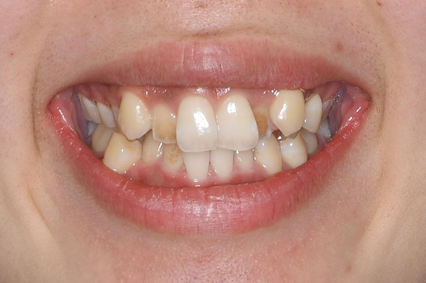上下重度ガタガタの上下顎抜歯症例（表側矯正装置）