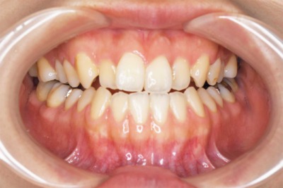 下顎前突症の非抜歯による外科的矯正治療