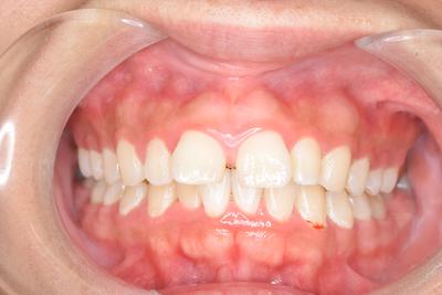 上顎の空隙歯列（すきっ歯）とガミースマイル
