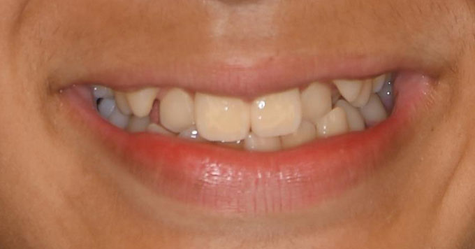 Ⅰ期治療からⅡ期治療の非抜歯症例＿表側矯正