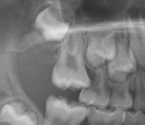 上下顎両側大臼歯がひっかかって埋まっている＿口ゴボ
