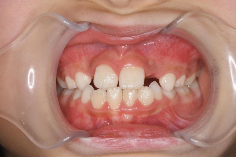 右上中切歯の交叉咬合症例