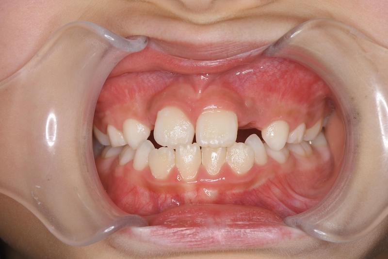 右上中切歯の交叉咬合症例