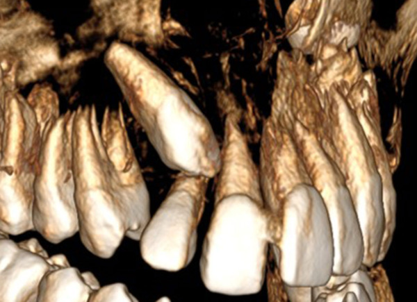 側切歯の歯根吸収を伴う犬歯埋没症例